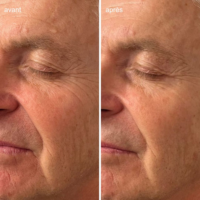 Images avant et après l'application du Masque visage tri-exfoliant pendant 5 minutes sur le visage d'un homme. Diminution visible de l'apparence des rides et ridules et des rougeurs.